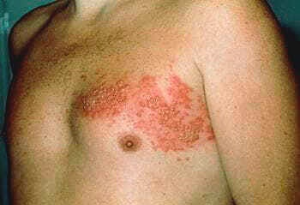 대상포진초기증상-사진