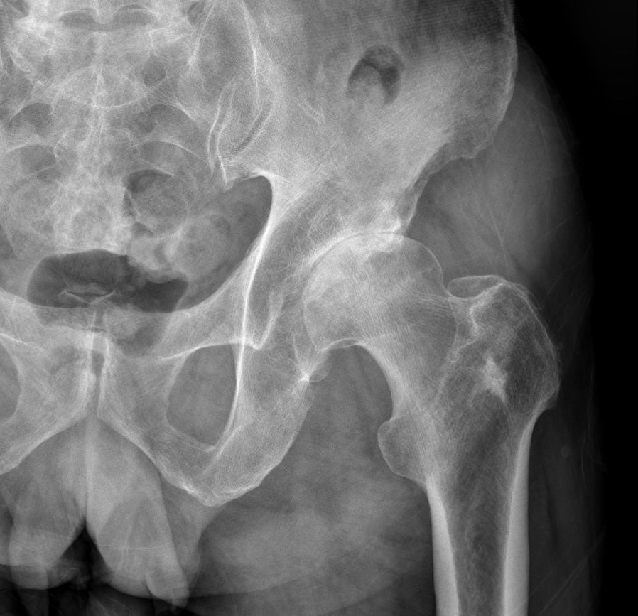 고관절 골관절염