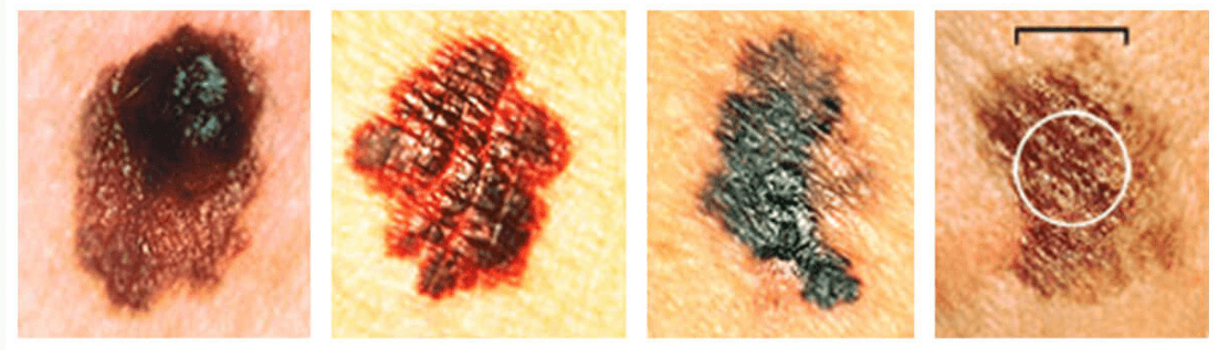 피부암 초기증상 흑색종