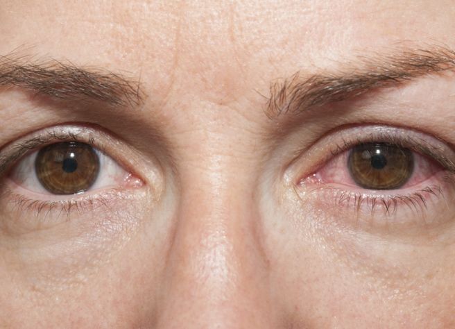 눈이 충혈되는 이유