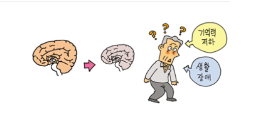 치매,치매초기증상,조기발견,치매자가진단,노년건강,치매예방,알츠하이머,치매검사,부모님건강,치매관리