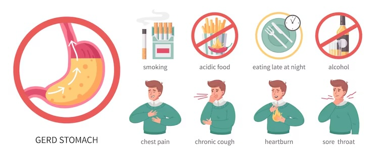 역류성 식도염 증상 - 가슴 통증, 속쓰림