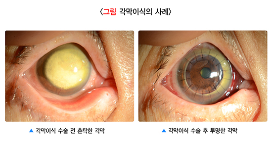 각막혼탁