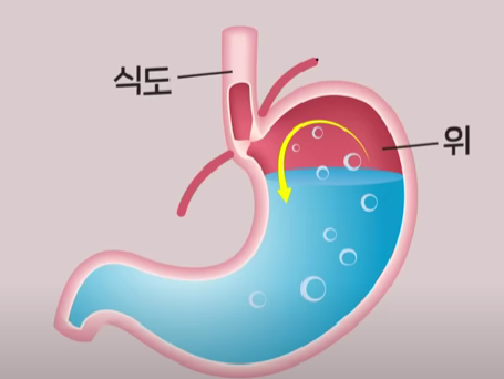역류성식도염 설명 이미지