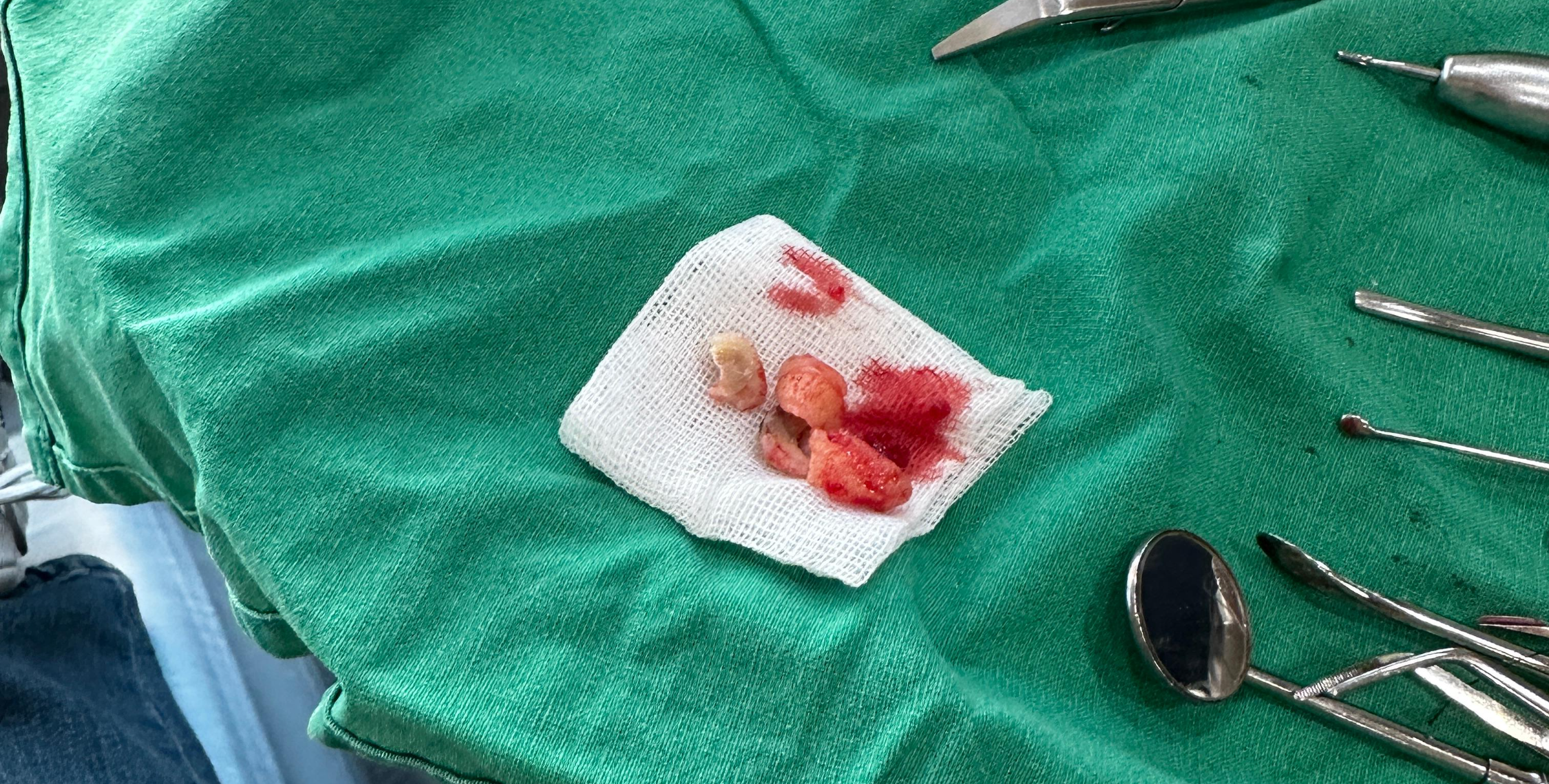 네 조각 사랑니