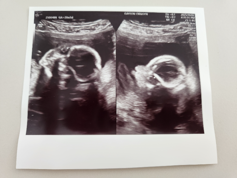 2차 정밀 초음파