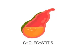 담석-제거-수술