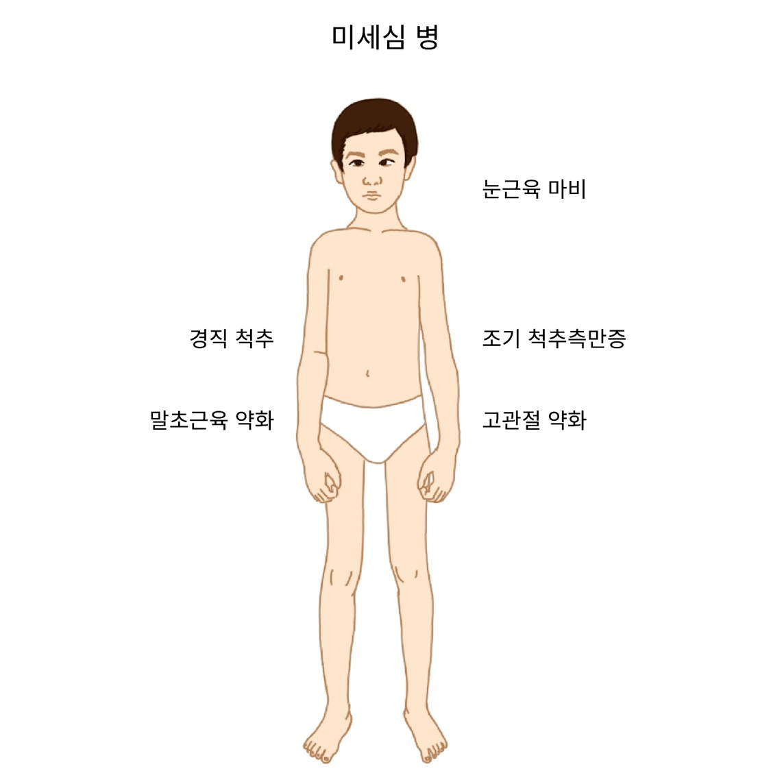 다중미세심병과 경직척주증후군