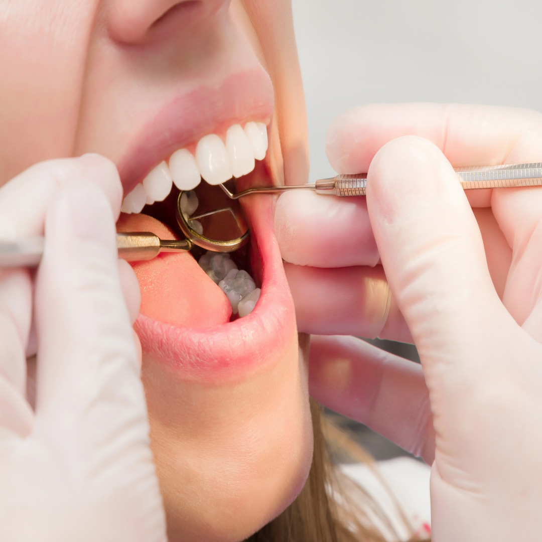 사랑니 뽑을까 말까, 발치 장단점 비교