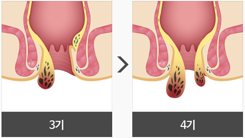 치질 증상