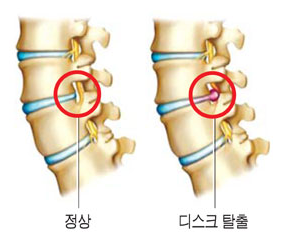 허리디스크 증상