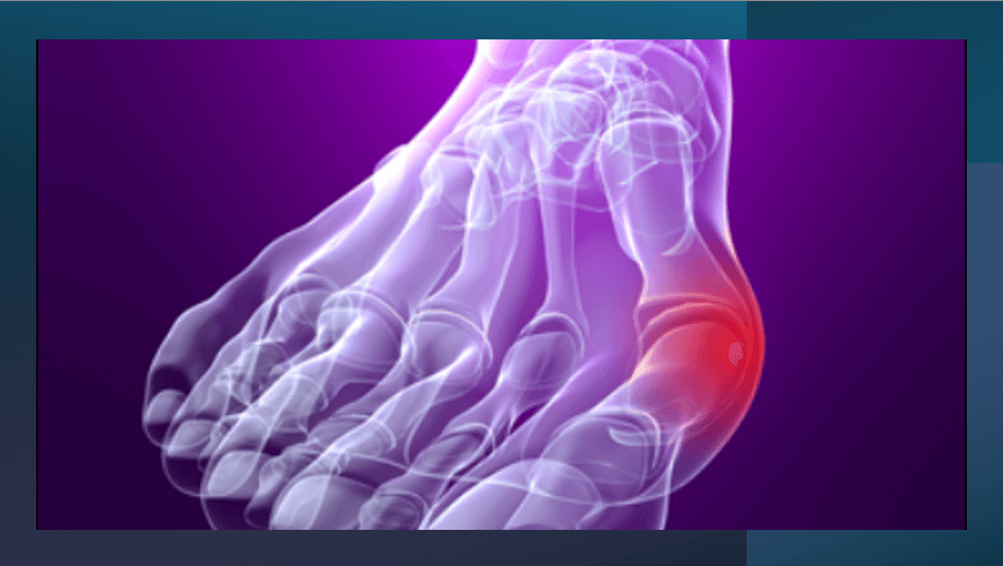 무지외반증: 발의 구조를 무너뜨리는 질환