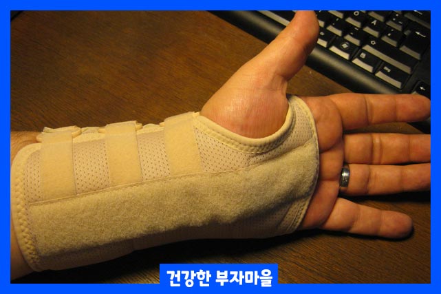 Carpal tunnel syndrome 수술 및 치료법