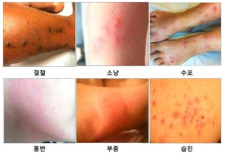 빈대