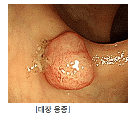 대장용종