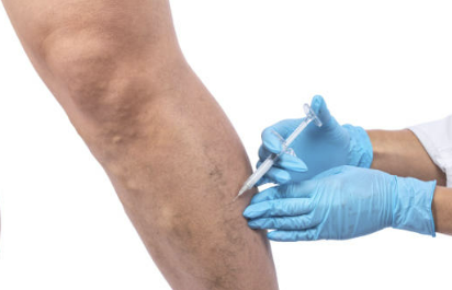 하지정맥류 증상&amp;#44; 수술비용&amp;#44; 도움이 되는 운동