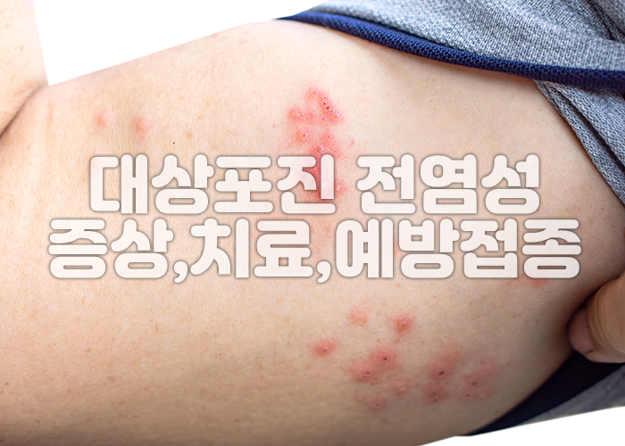 남자 팔뚝에 대상포진으로 인한 발진과 수포가 올라오고 있다