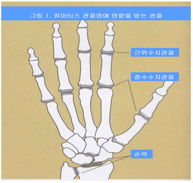 손의 류마티스 관절염 출처: 대한 정형외과 홈페이지
