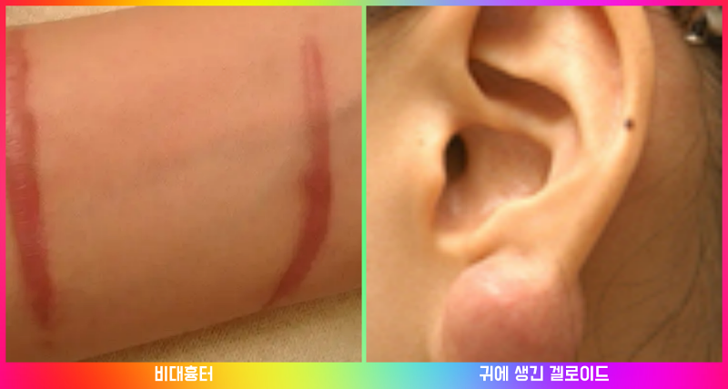 비대흉터와 켈로이드 차이