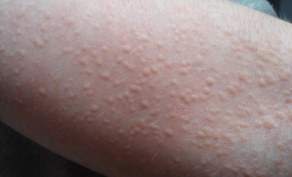 면역 불균형 두드러기 관리하는 법