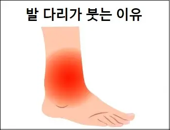 발 다리가 붓는 이유