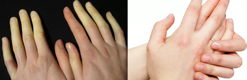 레이노이드 증후군과 수족냉증