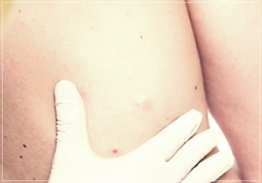 지방종 제거 수술: 원인, 절차, 비용