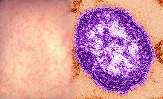 홍역 증상 완벽 가이드