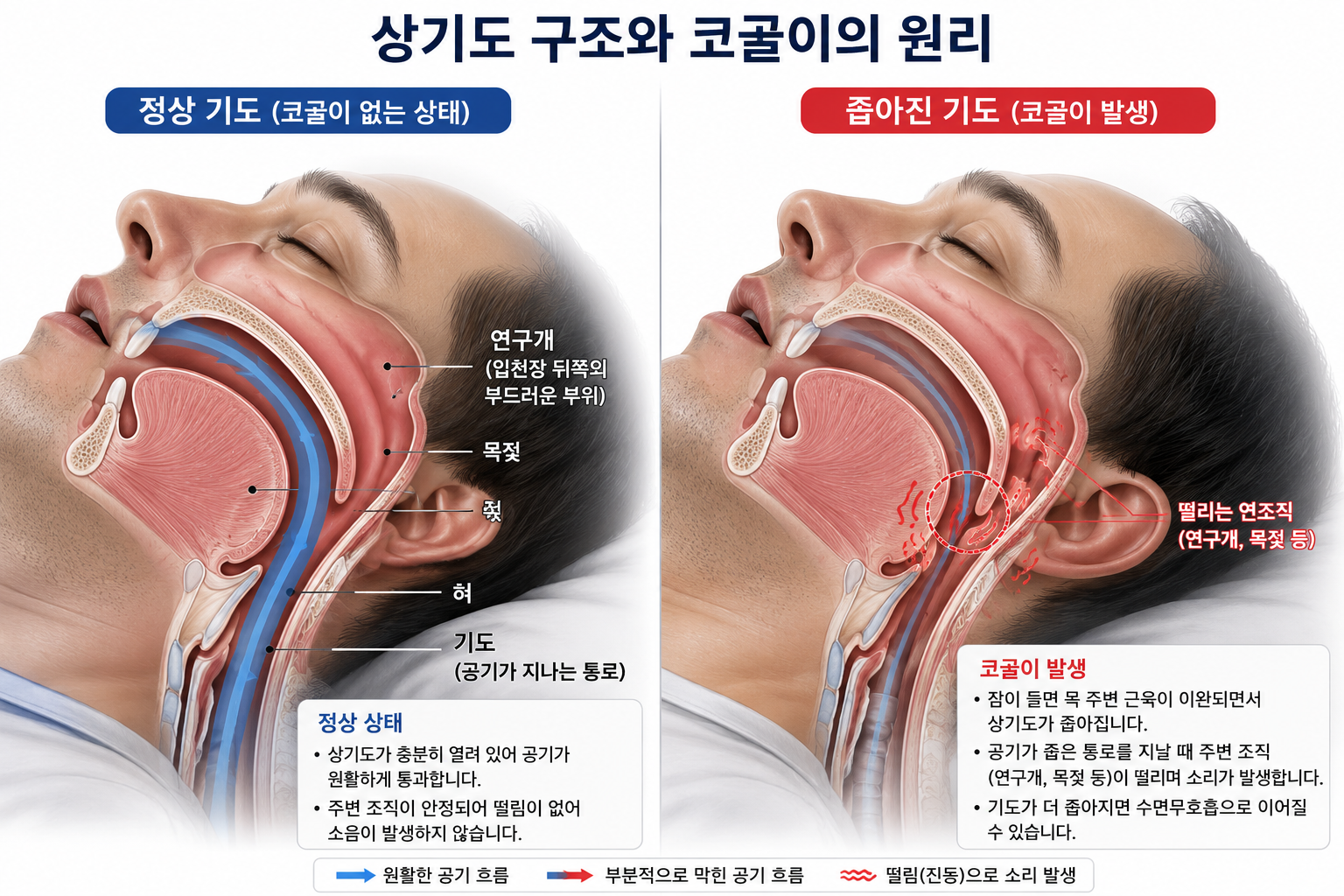 상기도 구조와 코골이의 원리 설명