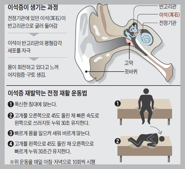 이석증 개선
