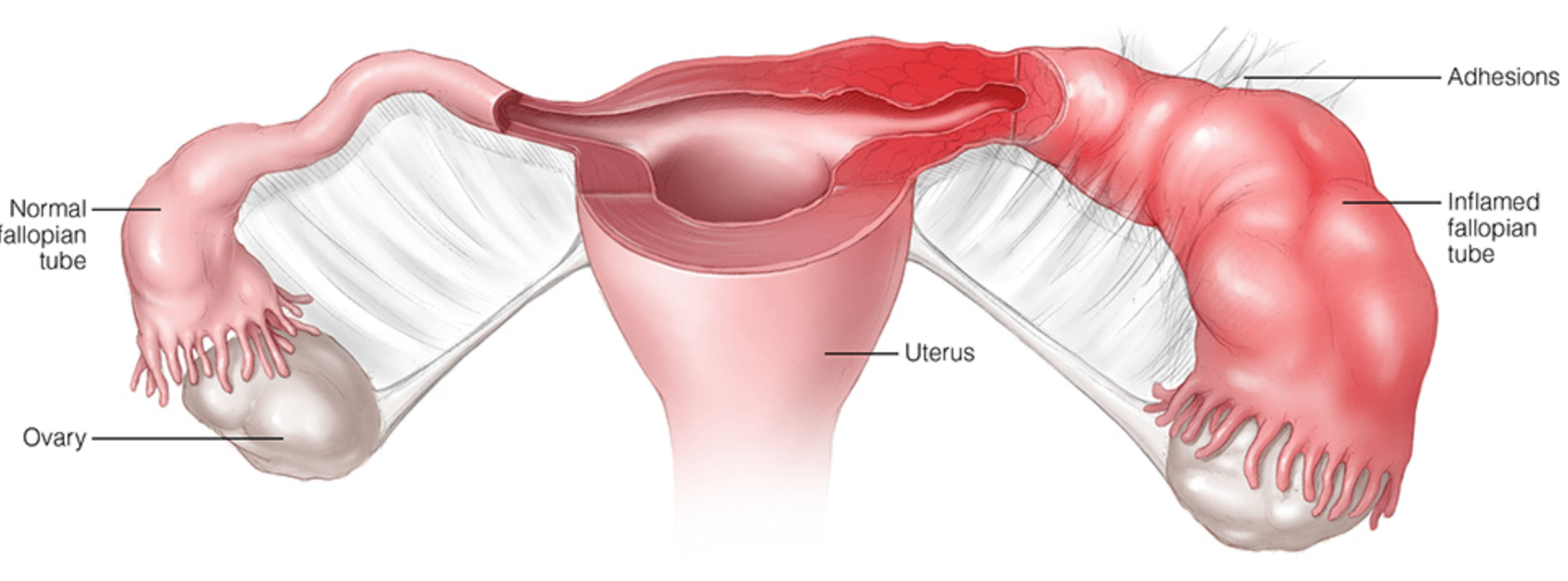 복통 원인 염증