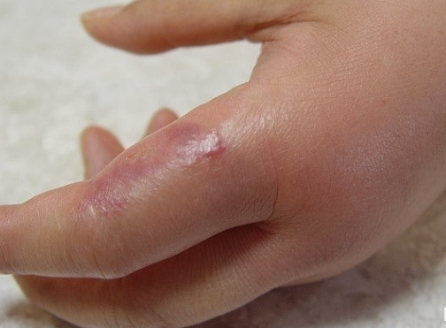 지네에 물렸을 때 대처법