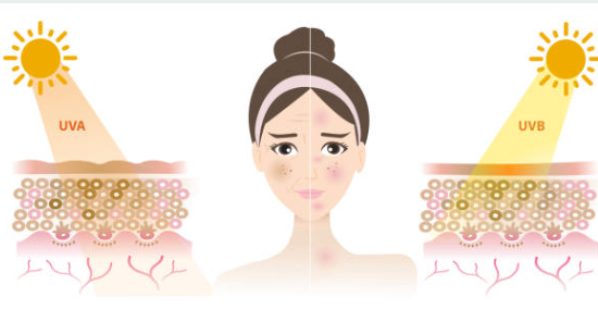 기미 자외선