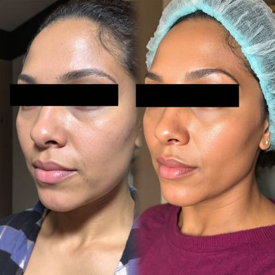 하이드로퀴논 vs 삼급뷰틸하이드로퀴논2