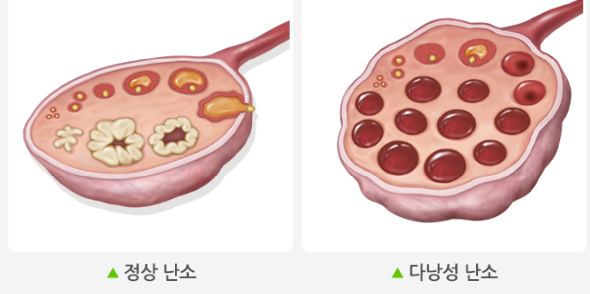 다낭성 난소 증후군 증상과 치료