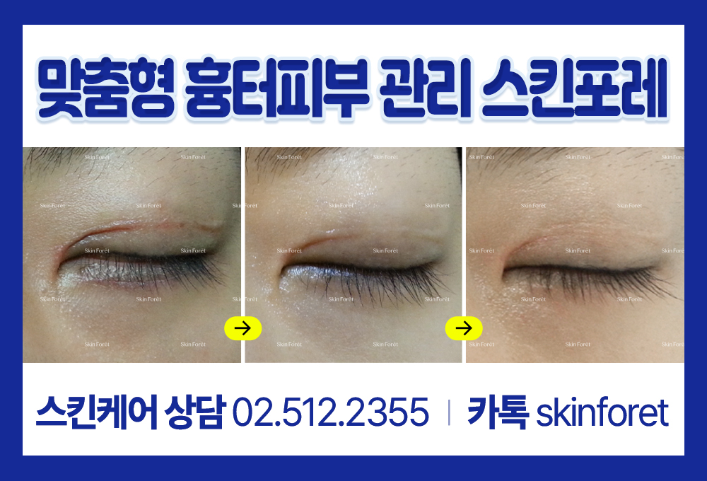 소세지눈과 함께 남은 쌍꺼풀흉터가 자연스럽게 정돈된 모습