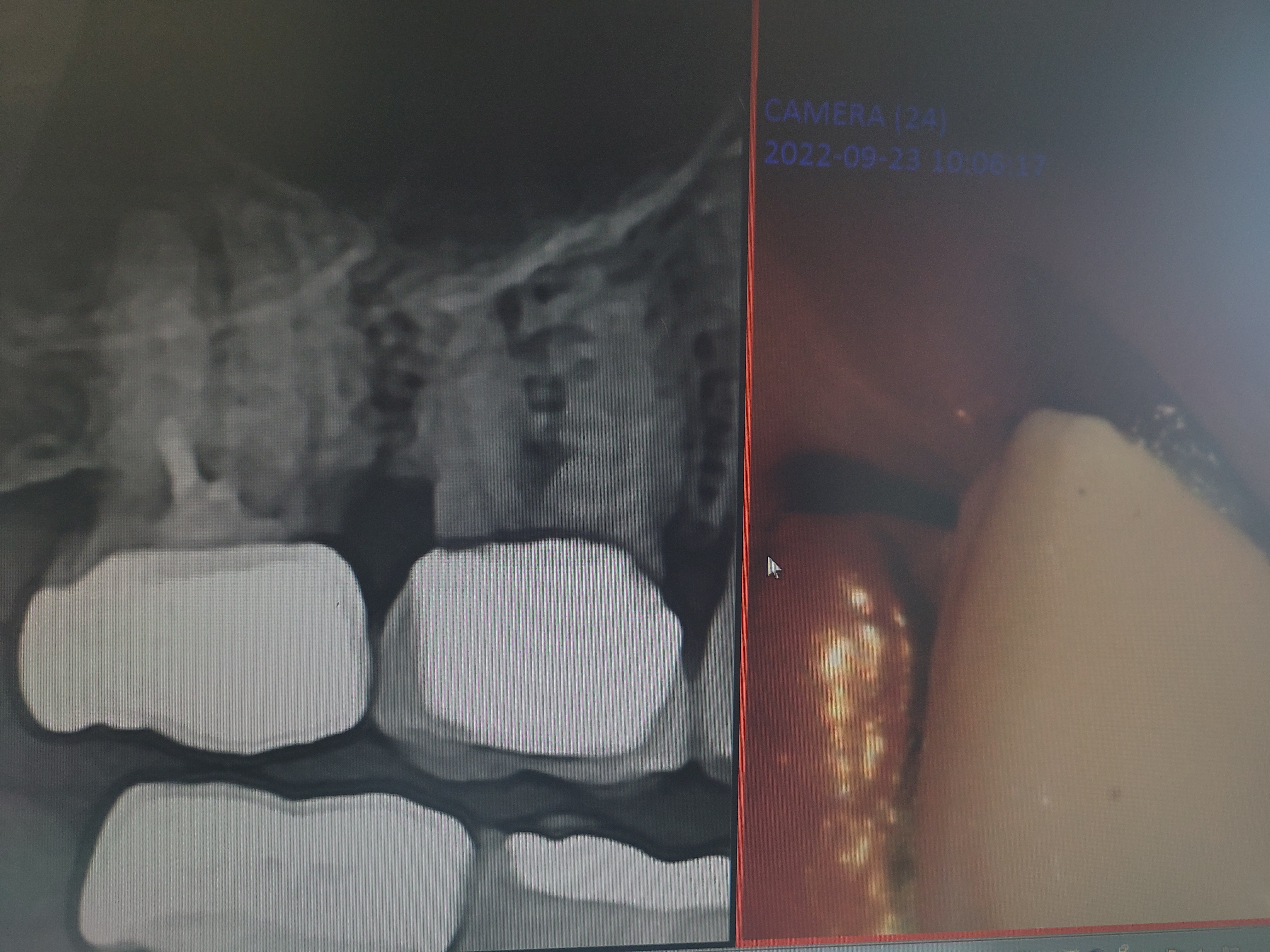 골드크라운, 지르코니아 크라운