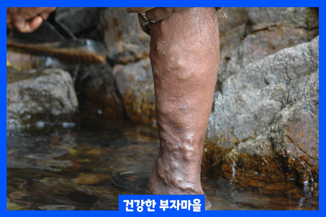 하지정맥류 초기증상 11가지