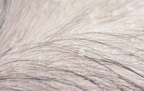 지루성 두피염 완벽 가이드: 증상, 원인, 치료, 관리, 샴푸, 후기까지!