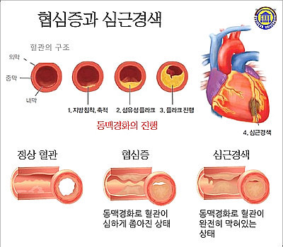 정상혈관, 협심증, 심근경색의 상태를 비교해 보여주는 일러스트로 정상 혈관은 동맥경화가 없고, 협심증 혈관은 동맥 내부에 플라크가 축적되어 혈관이 좁아졌으며, 심근경색 혈관은 혈전으로 인해 혈관이 거의 완전히 막힌 모습을 표현한 이미지