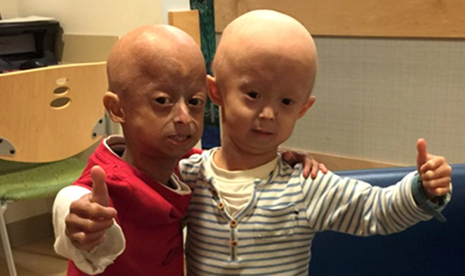 소아 조로증 수명 및 소아조로증 원인과 치료방법