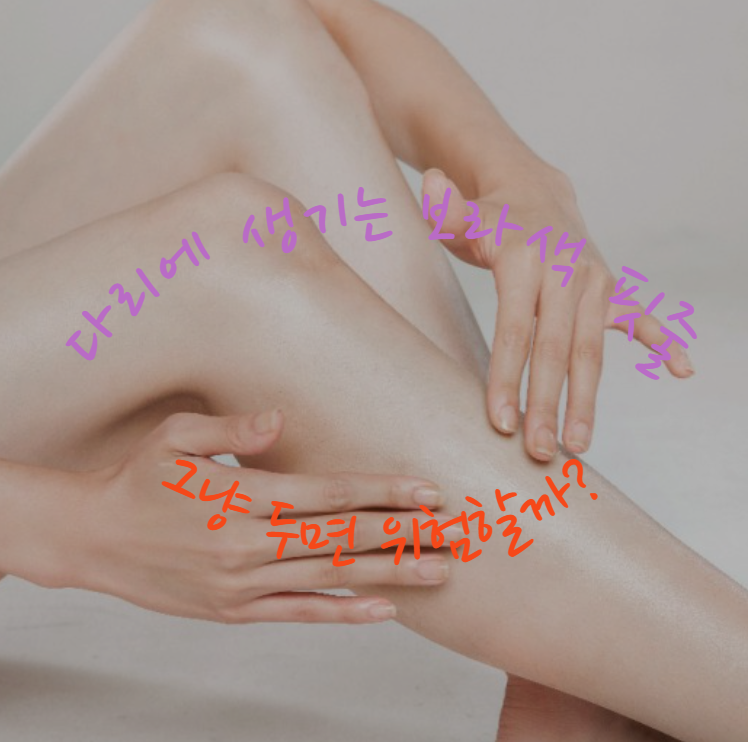 다리에 생기는 보라색 핏줄, 그냥 두면 위험할까? 부종·저림 증상까지 체크!