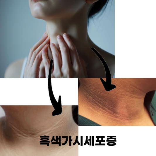 흑색가시세포증