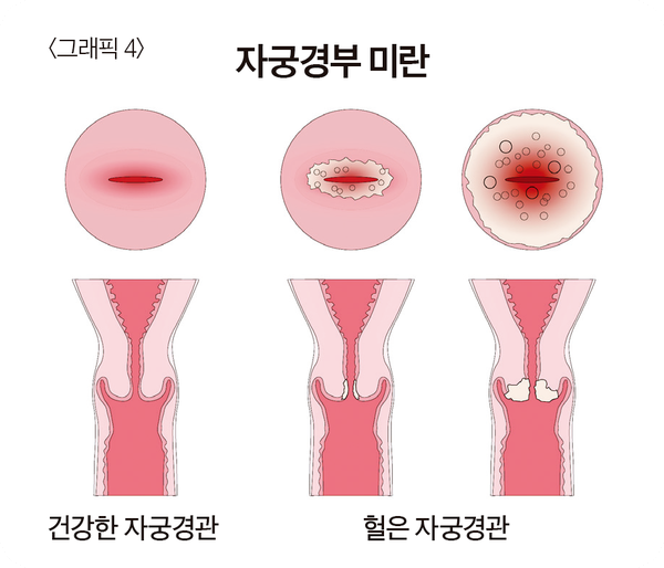 자궁경부미란