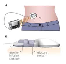 당료관리,연속혈당측정기,CGM