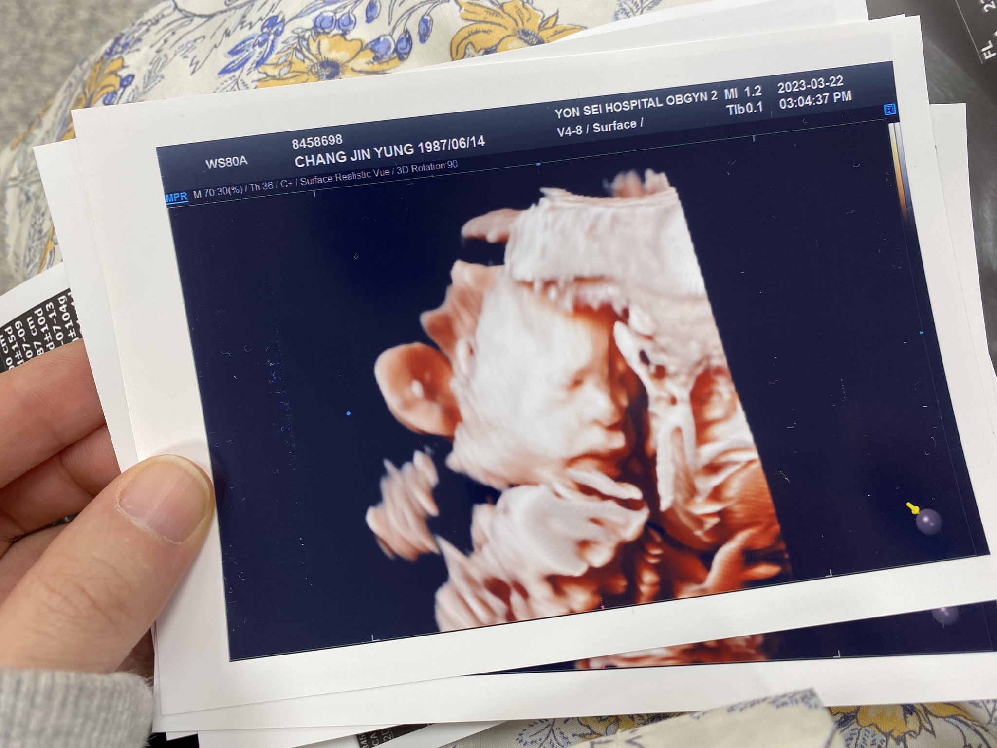 세브란스입체초음파