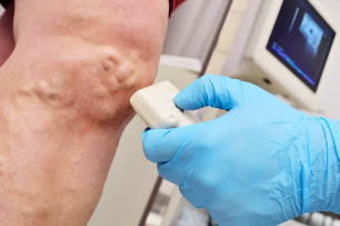 하지정맥류 치료