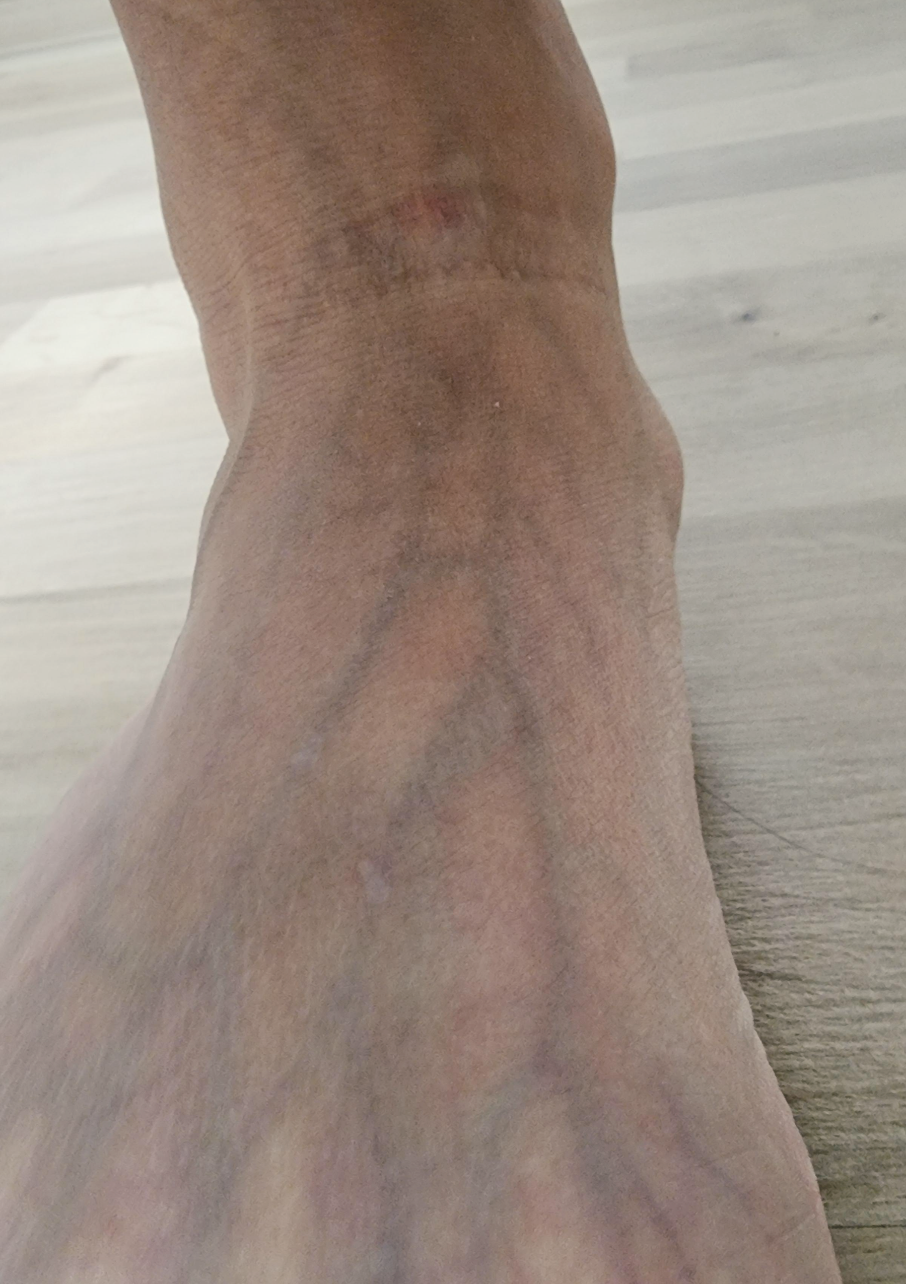 발 안쪽 뼈 통증