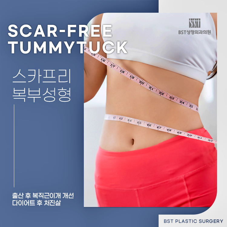 다이어트 후 처진살, 출산 후 복직근이개를 개선하는 BST성형외과 스카프리 복부성형