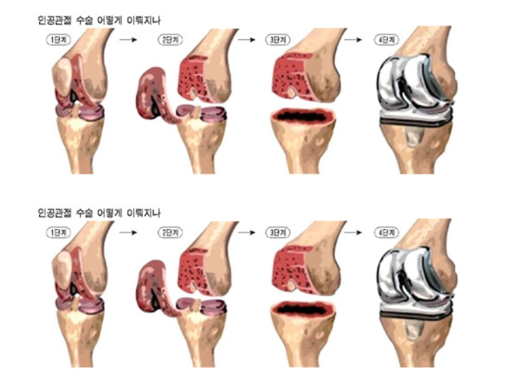 무릎 인공관절 수술